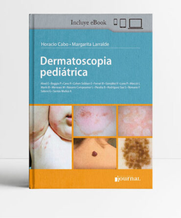 Dermatoscopia pediátrica 1era edicion - Larralde