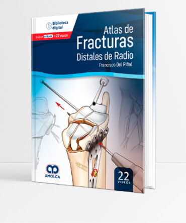 Atlas de Fracturas Distales de Radio 1era edición - Del Piñal